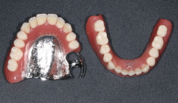 Metal Based Dentures
